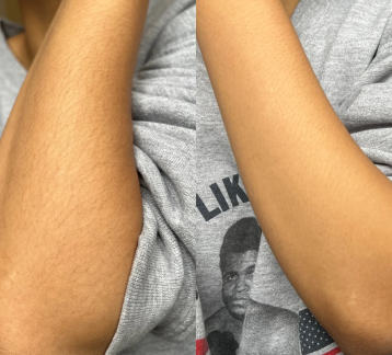 arm hair before and after using body hair trimmer